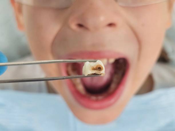 Best Emergency Wisdom Teeth Removal in Cienega Springs, AZ